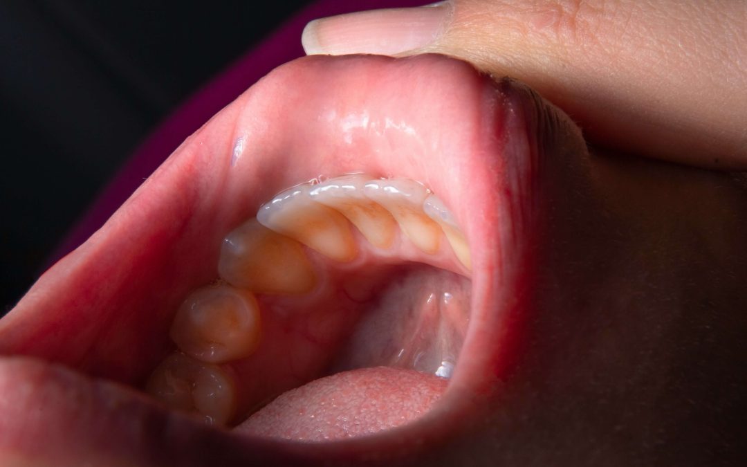 Afta u ustima – bolna lezija na oralnoj sluznici