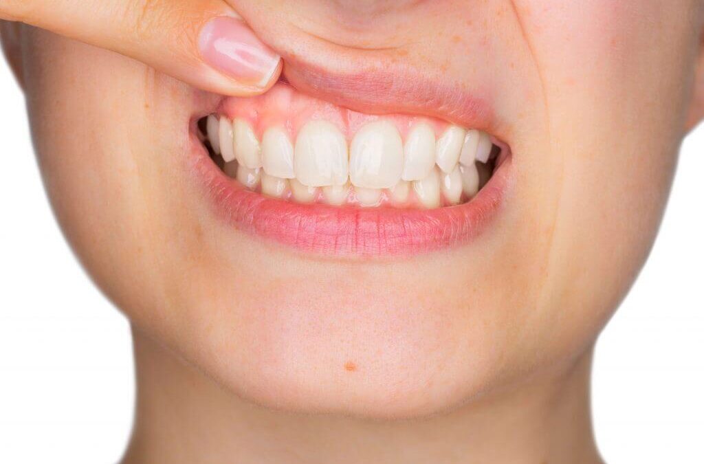 Parodontološki pregled i terapija za liječenje parodontitisa, gingivitisa i povlačenja desni