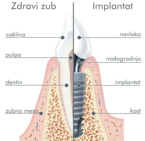 city of dental implant