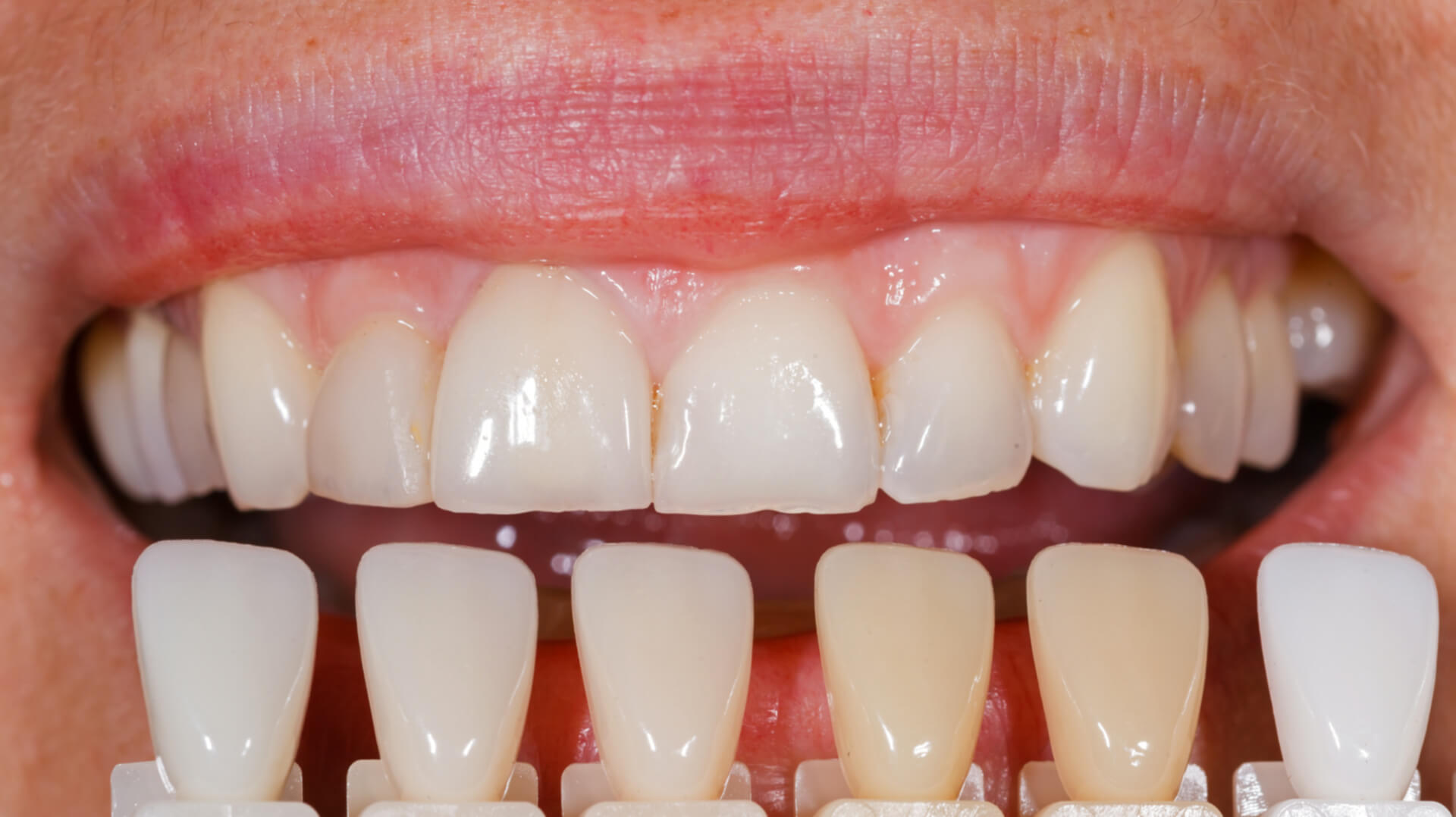 izbjeljivanje zubi