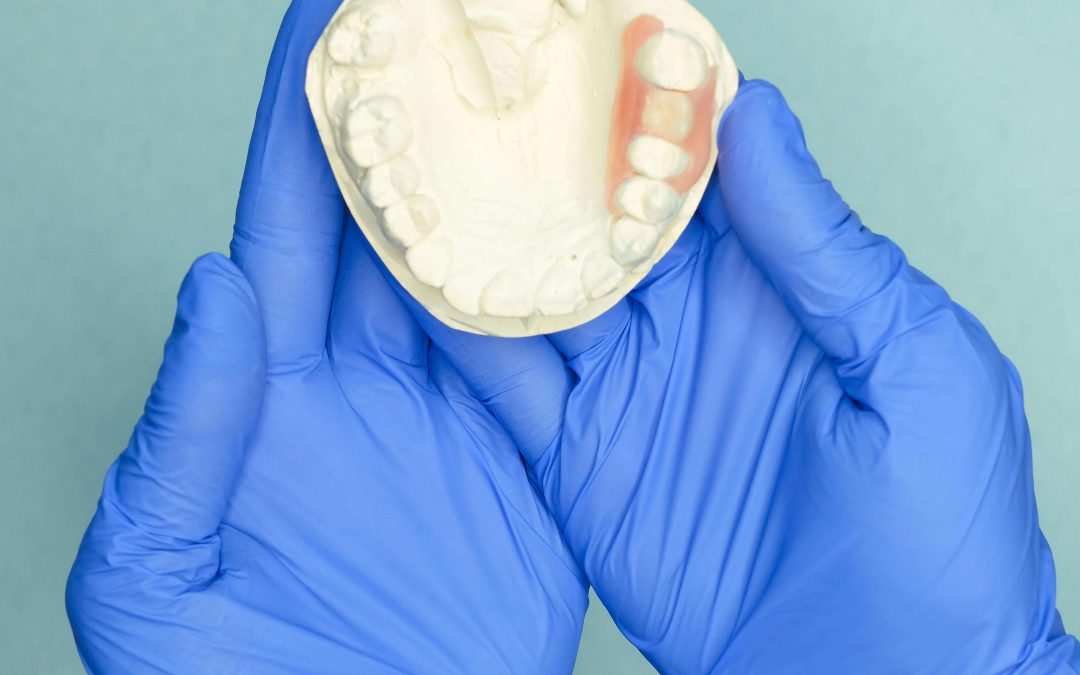 Krunica i most – protetska rješenja za oštećene ili izgubljene zube