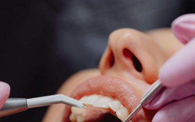 Higijena zubnih implantata