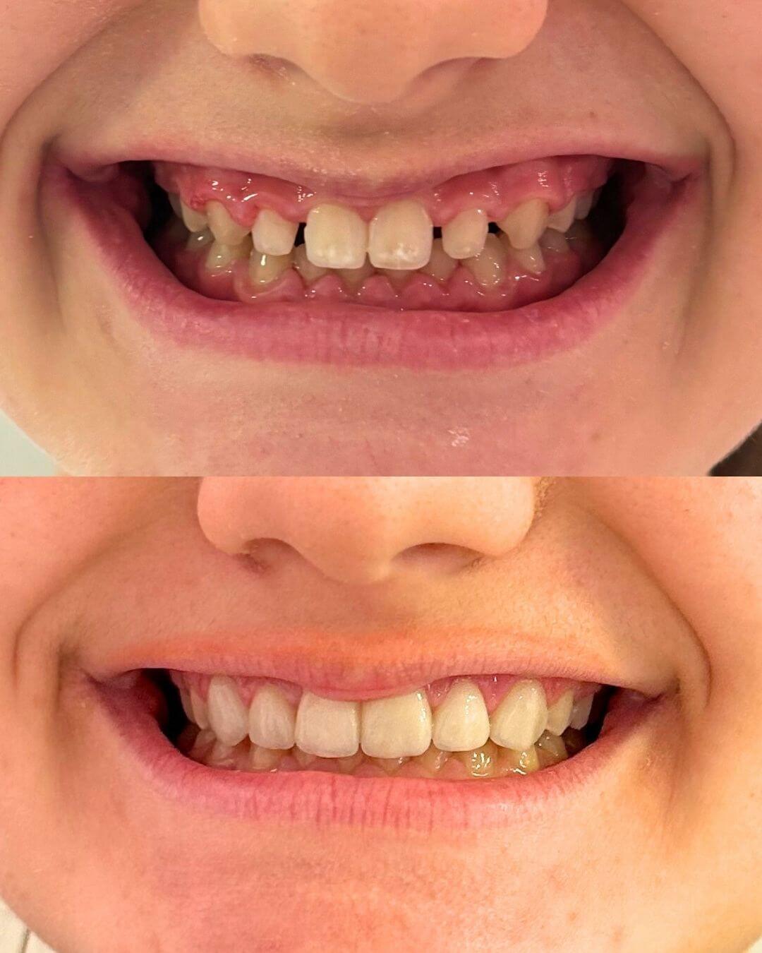 Prije i poslije keramičkih ljuskica – ispravljanje nepravilnih i razmaknutih prednjih zuba