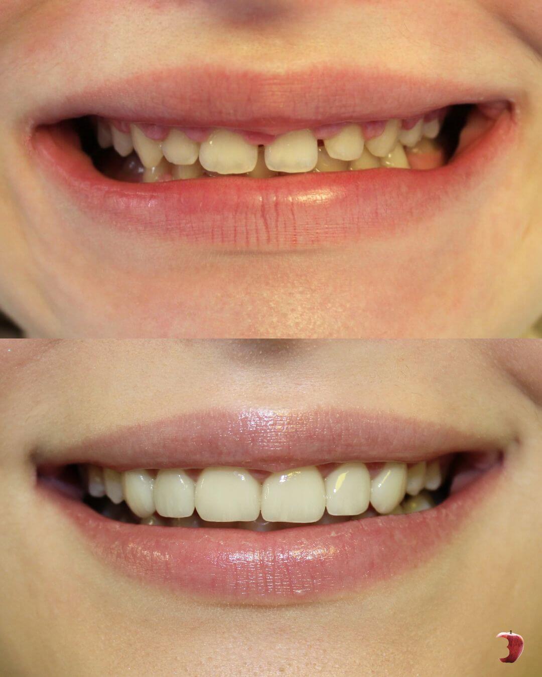 Prije i poslije keramičkih ljuskica – korekcija boje, oblika i nepravilnosti prednjih zuba