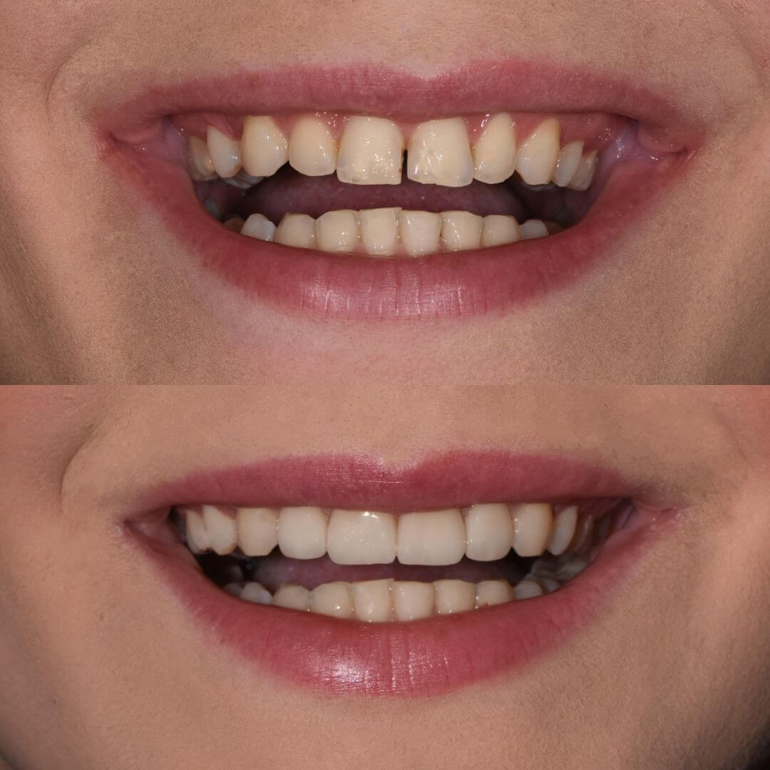 Prije i poslije keramičkih ljuskica (E-max) – estetska korekcija prednjih zuba i prirodan osmijeh