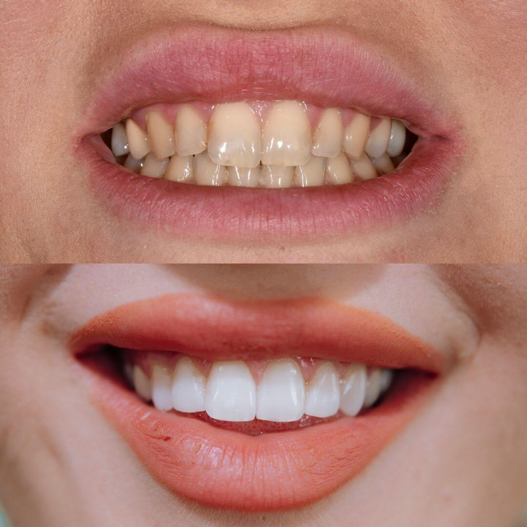 Prije i poslije kompozitnih ljuskica – izbjeljivanje i korekcija oblika prednjih zuba