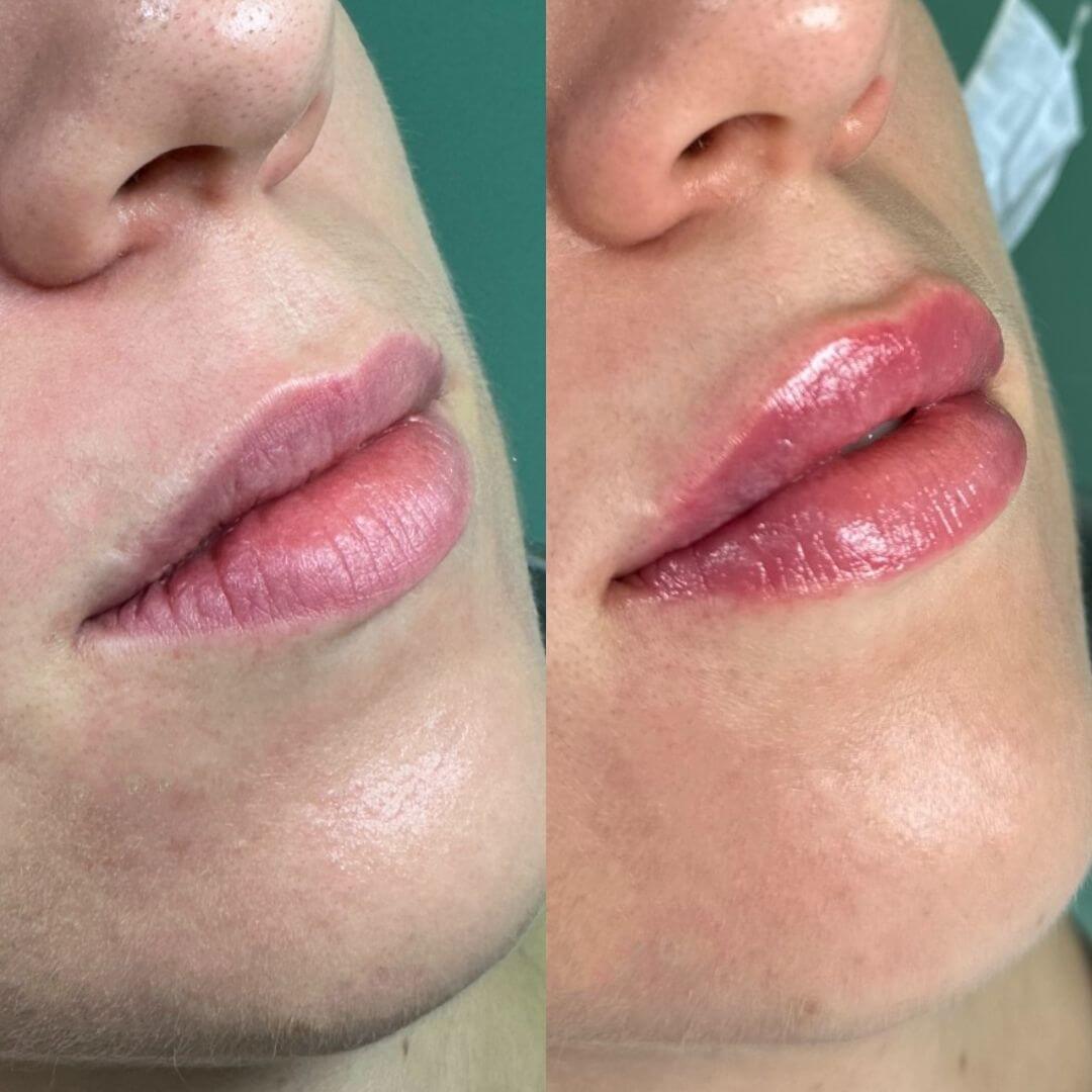 Prije i poslije hijaluronskih filera usana – povećanje volumena i definicija konture