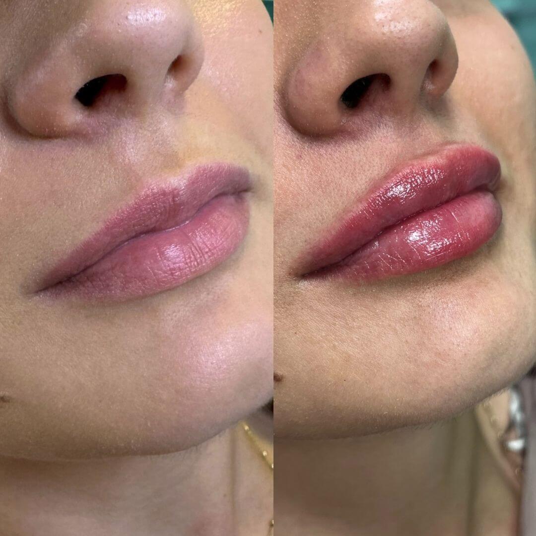 Prije i poslije filera usana – prirodno povećanje volumena i hidratacija usana