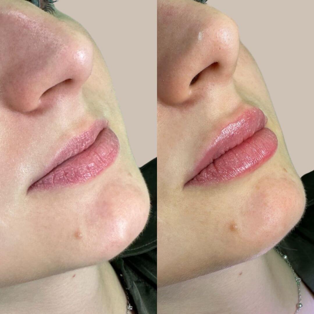 Prije i poslije filera usana – korekcija oblika i blago povećanje volumena