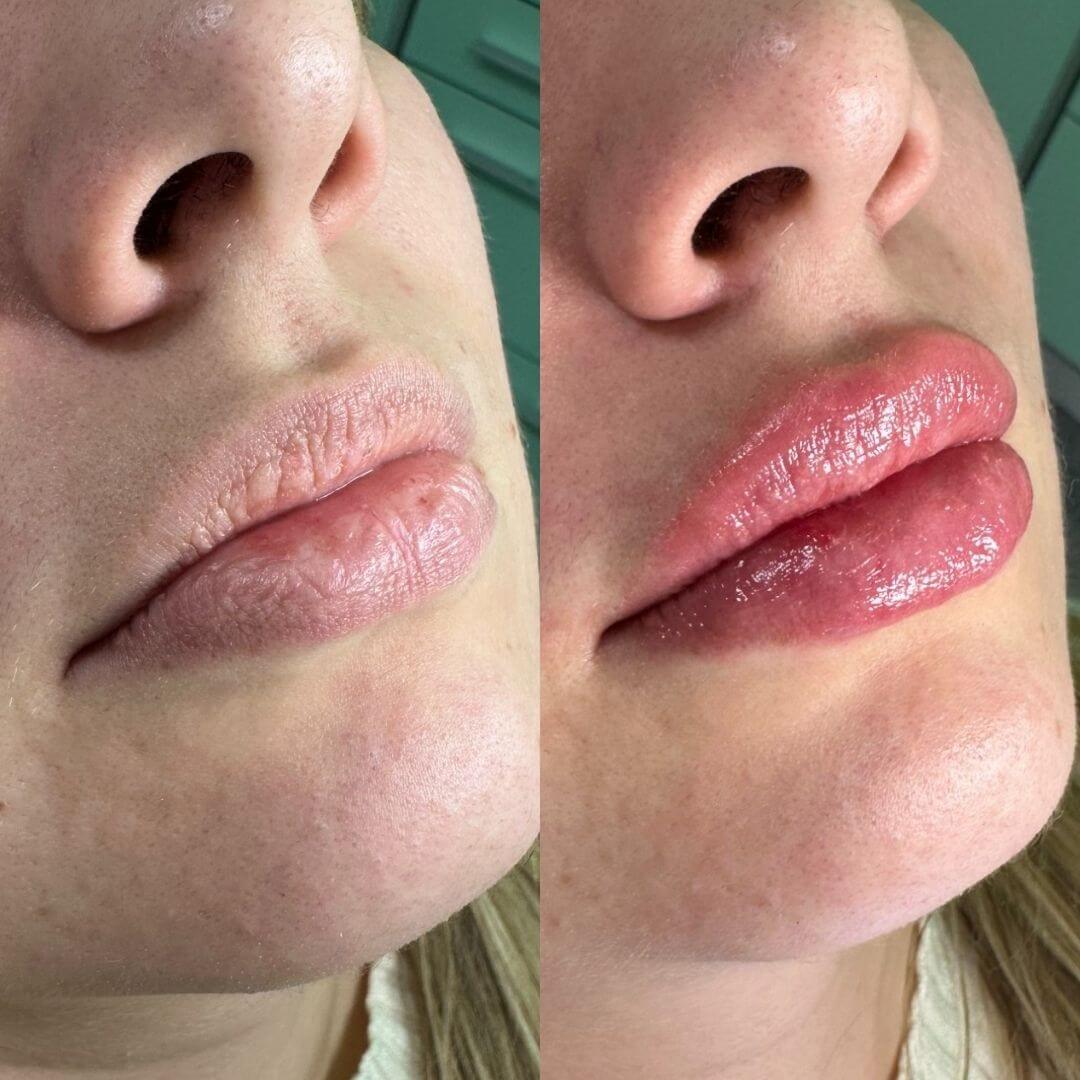 Prije i poslije filera usana – povećanje volumena i dubinska hidratacija usana