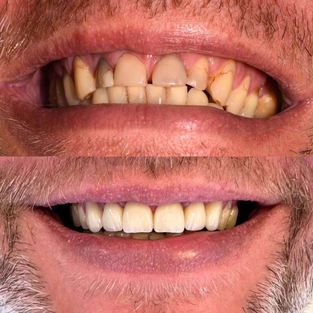 Prije i poslije cirkon krunica – sanacija oštećenih i istrošenih zuba