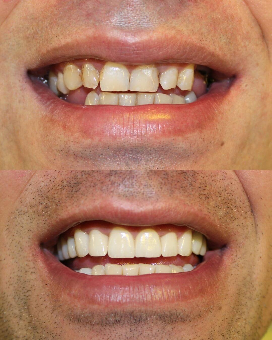 Prije i poslije cirkon krunica – potpuna rekonstrukcija i estetska transformacija zuba
