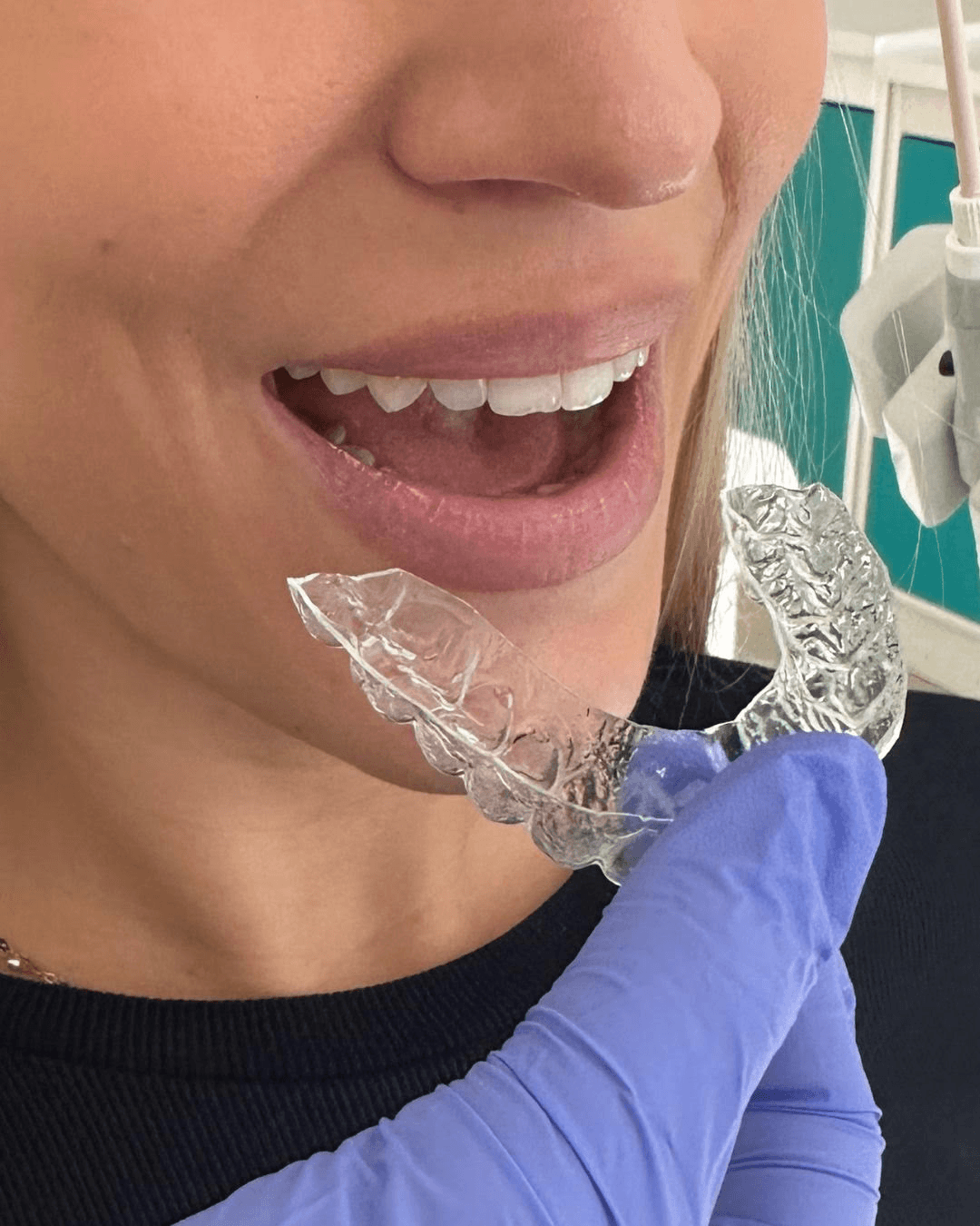 Bruksizam – škripanje i trošenje zubi tijekom noći