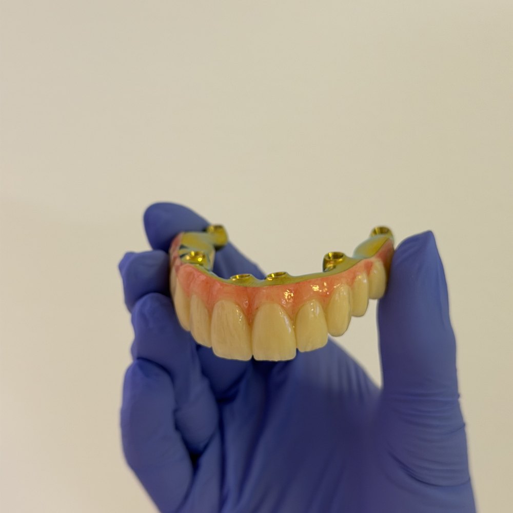 All-on-4 fiksni rad s vidljivim nosačima na implantatima