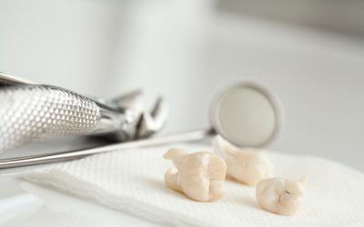 Umnjak – kada ga treba vaditi, a kada ne?